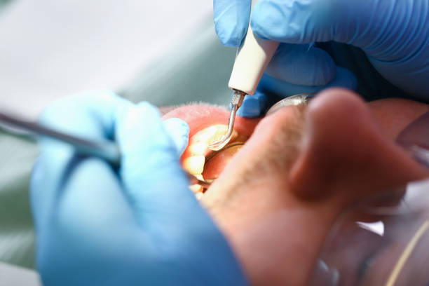 Best Emergency Dentist for Lost Fillings or Crowns in Gallatin, TN